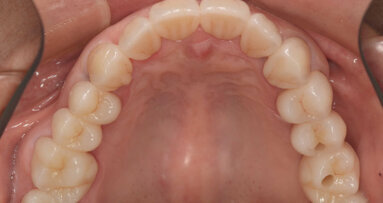 Encore un peu plus près de la nature : concepts occlusaux et esthétique raffinée en dentisterie numérique