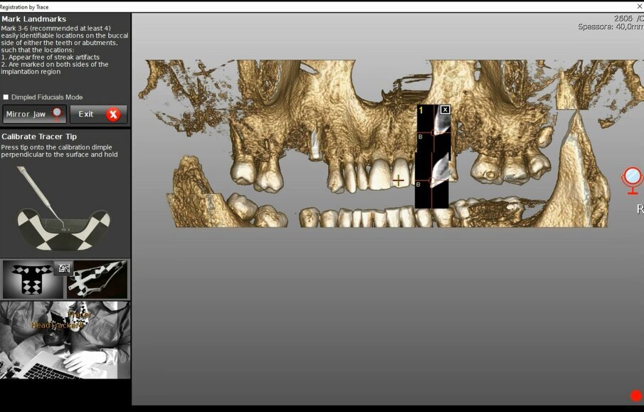 Figg. 6a-6d - Tracciatura della superficie di riferimento in tempo reale. a) Calibrazione del tastatore; b) Selezione dei denti e dei punti di partenza della scansione per tastatura; c) Fasi di scansione (tracer registration); d) Dettaglio clinico della procedura di tracer registration.