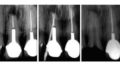 Non-surgical retreatment following failed apicoectomy with re-use of intra-radicular restoration