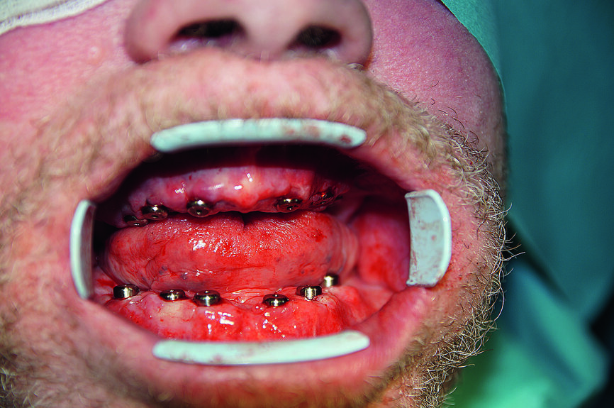 19 : Résultat de l’implantation avec tous les implants in situ.