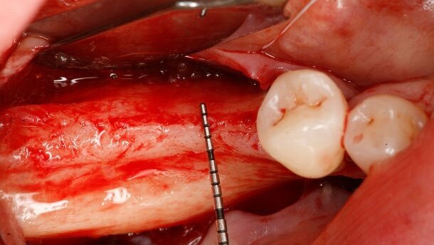 Výzkumník z Maďarska představí unikátní techniku augmentace kosti „sausage technique“