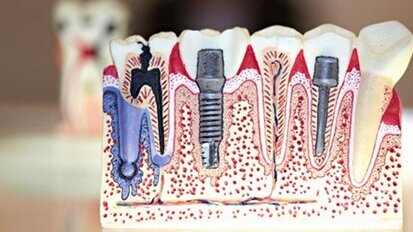 Haben Sozialhilfeempfänger  Darlehensanspruch beim Zahnersatz? Haben Sozialhilfeempfänger  Darlehensanspruch beim Zahnersatz?