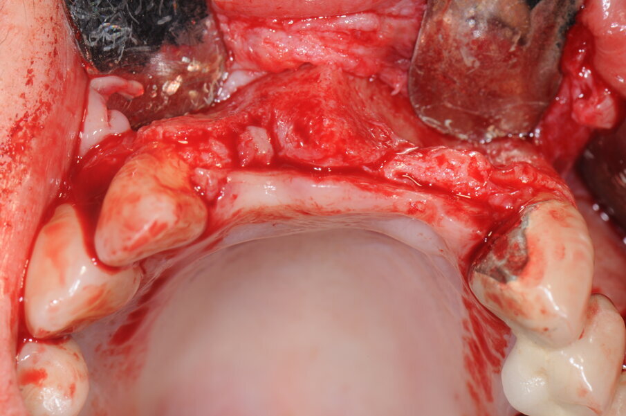 Figg. 8a, 8b - Esposizione del sito chirurgico e valutazione dei volumi ossei.