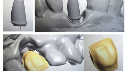 Valoración estética de la restauración protésica sobre implantes