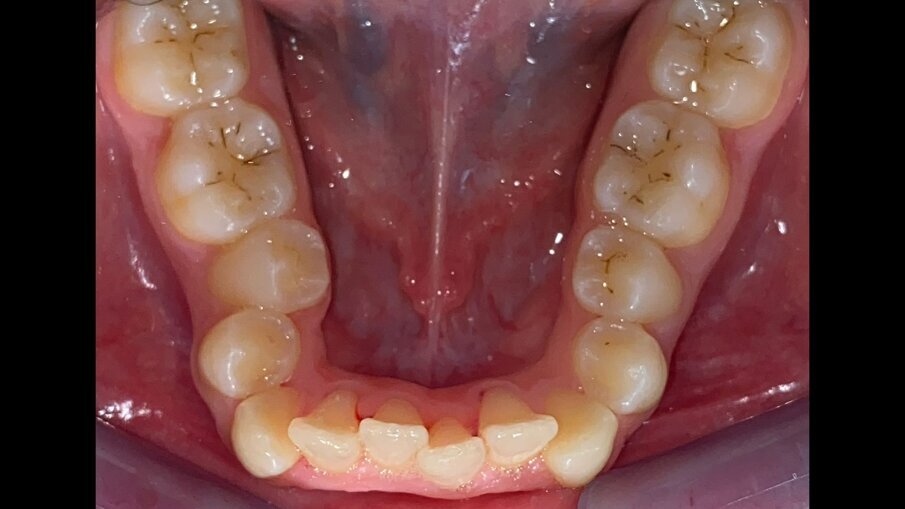 Fig. 9_Occlusale inferiore pre-trattamento.