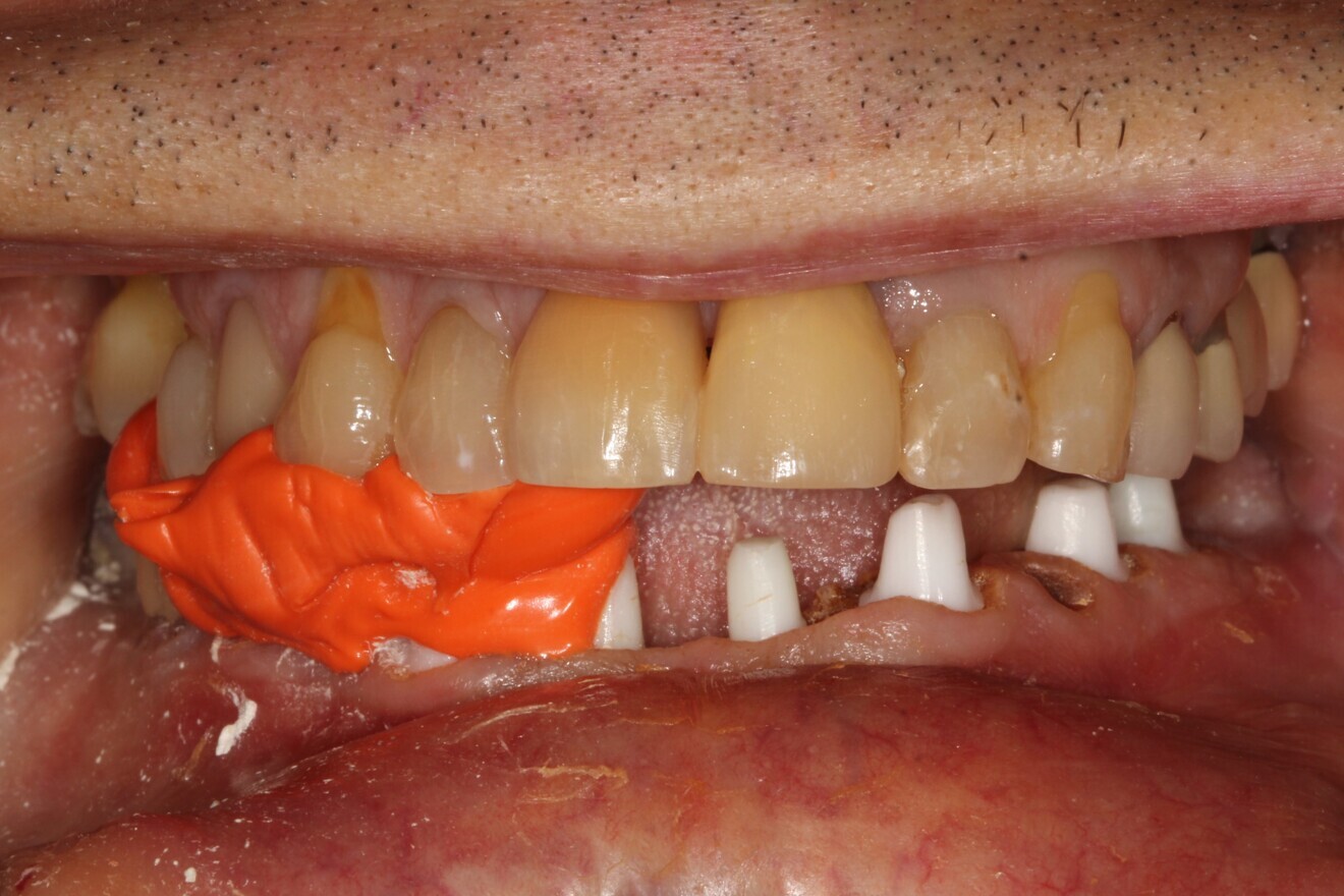 Fig. 11: Bite jig in place to maintain the vertical dimension of occlusion and test the vertical clearance.