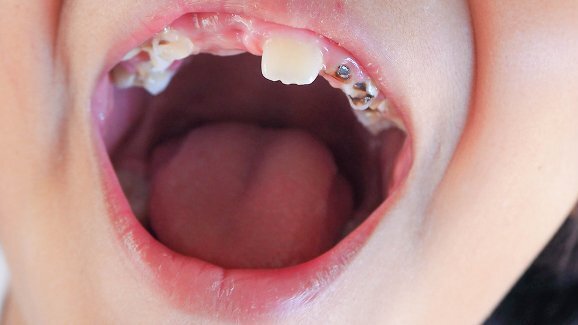 Relatório de Porirua indica disparidade na saúde bucal das crianças