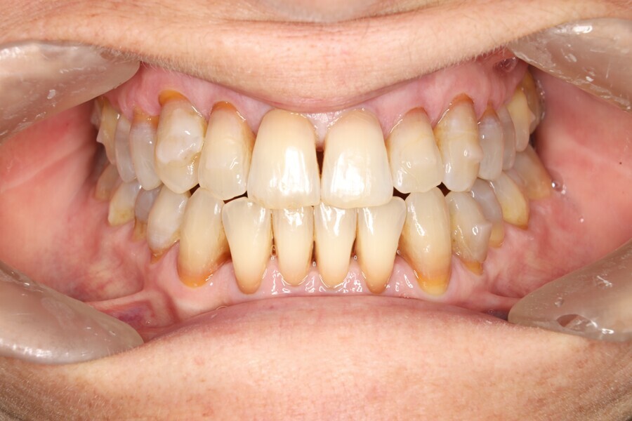 Fig. 39: Intermediate stage of Reveal aligners. Aligner #32.