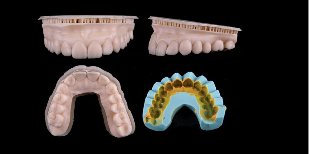 Fig. 4: 3D-printed models of the digital wax-up and the silicone matrix.