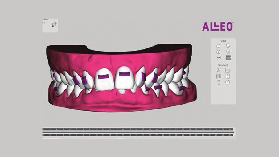 Figg. 5a-5c_View ALLEO ci permette la visualizzazione del set-up, la quantità di stripping necessaria per ottenere un corretto allineamento, la posizione degli attachments, oltre al report biomeccanico preciso di tutti i movimenti dentali proposti all’interno del set-up.
