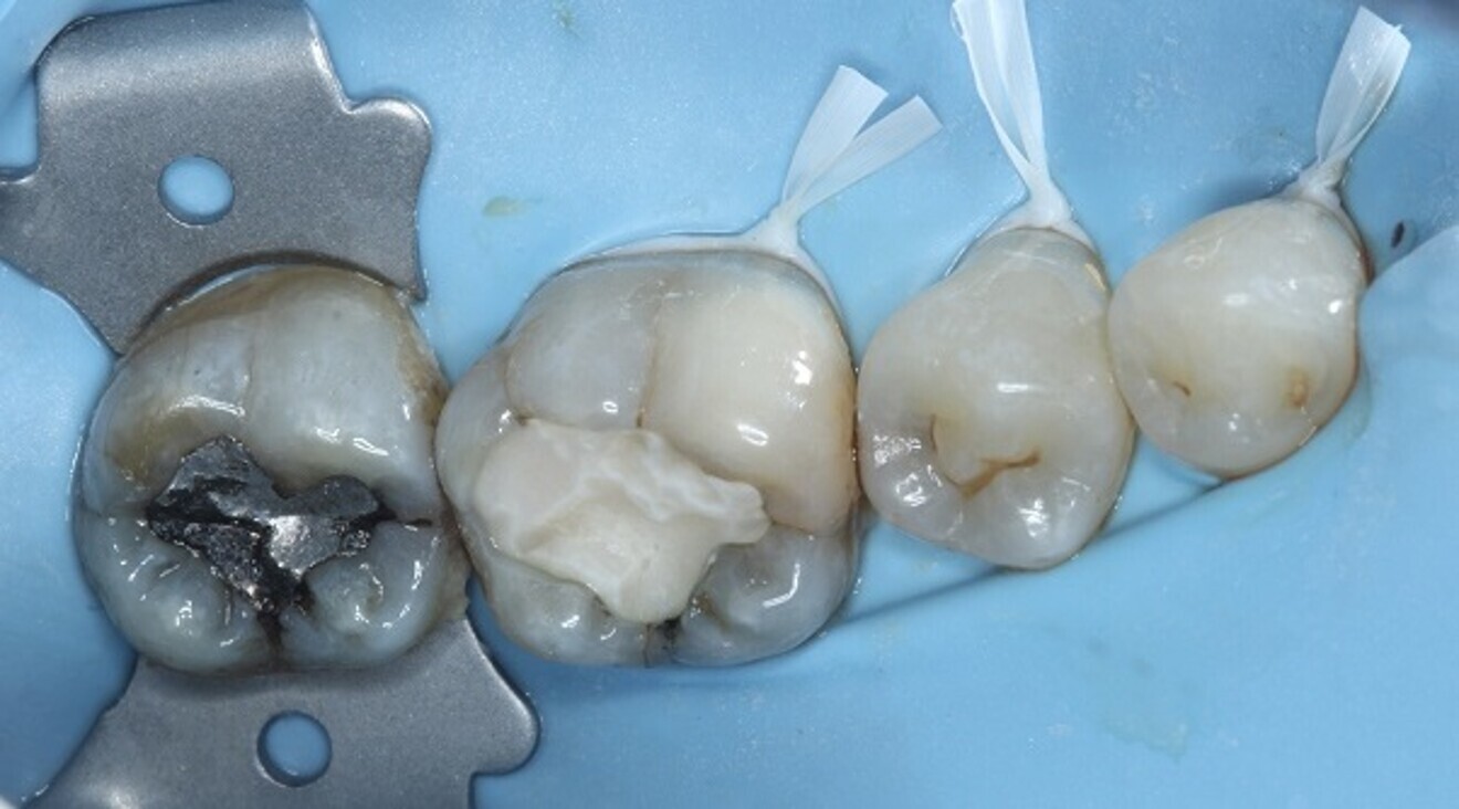 Fig. 2: Dental dam isolation.