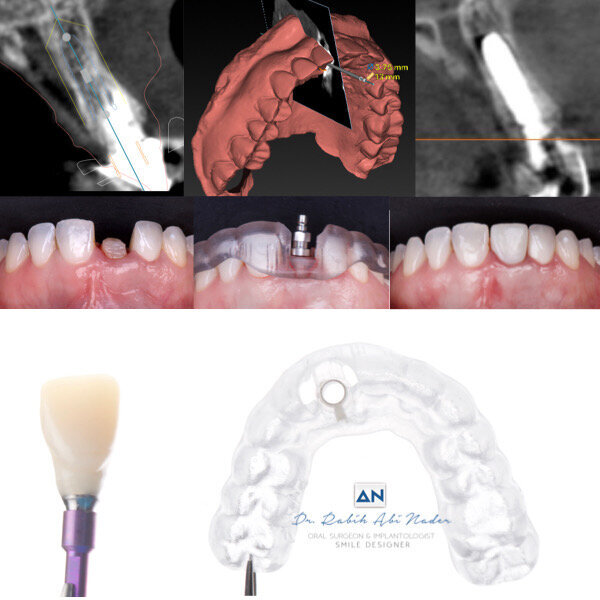 Figs. 12a–f: Pre-op CBCT scan showing the resorbed root of tooth #11 (a). Caption (b). Post-op CBCT scan showing the position of the implant in the extraction site (c). Caption (d). A surgical guide was manufactured to help place the implant in the optimum position with respect to the soft and hard tissue (e). Provisional screw-retained crown placed for six months to serve as a guide for soft- and hard-tissue healing (f).