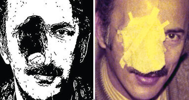 Maxillofacial prosthesis: it can happen to anyone