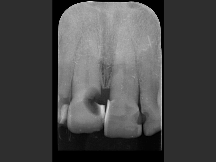 Fig. 2a - Valutazione radiografica iniziale: radiografia intraorale.