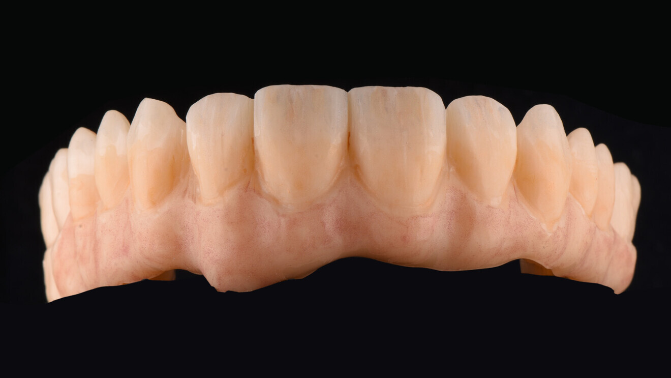 Fig. 3: After application of CERABIEN MiLai SS Fluoro and internal stains to enhance the natural shading of the restoration in the dental and gingival areas. 