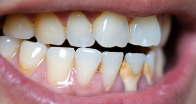 Tandarts Charlotte Jorna: “Tandsteen is zoals een kalkkring in de wasbak”