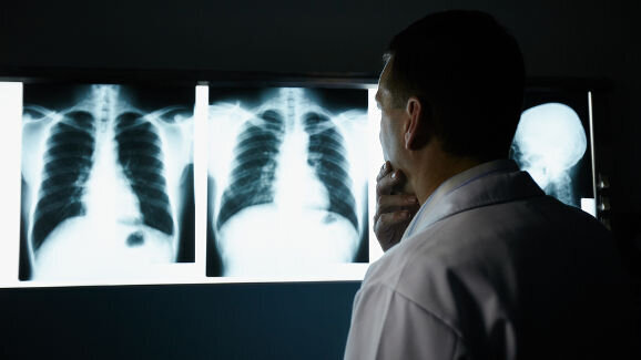 Des chercheurs espèrent développer un test de l’haleine pour le diagnostic du cancer du poumon