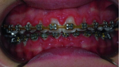 Clinical view, showing gingival enlargement, just before the debonding procedure.