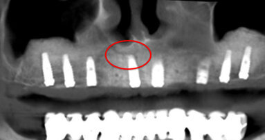 Il Canalis Sinuosus: una struttura anatomica da conoscere e rispettare