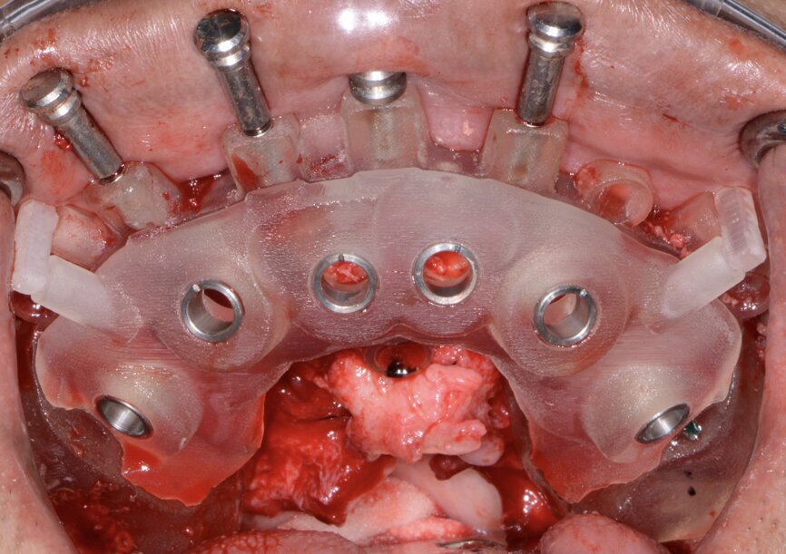 Fig. 11: Maxillary implant surgical guide.