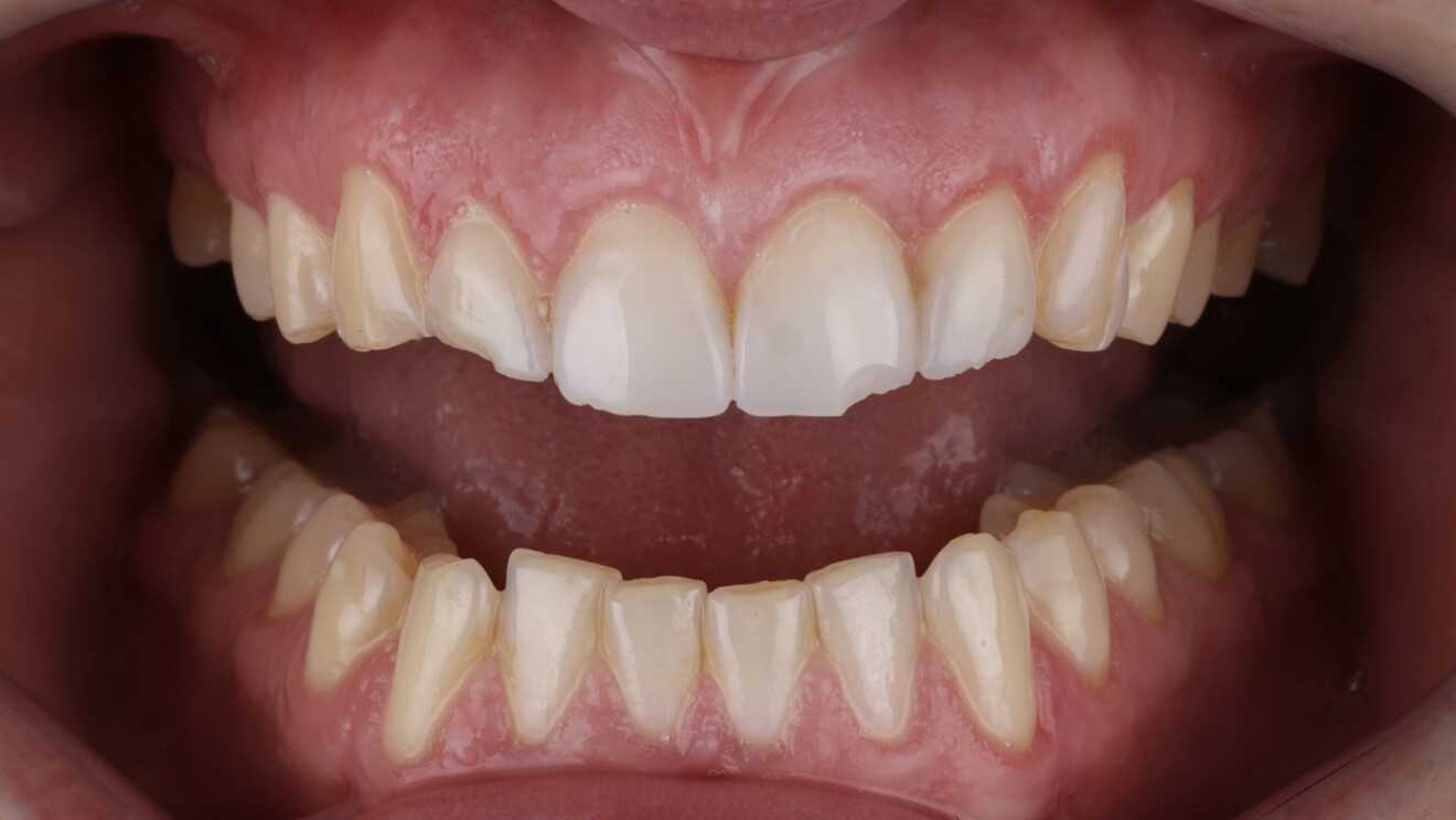 Fig. 1d: Intra-oral frontal view with the teeth apart.