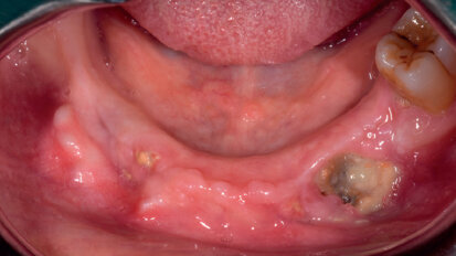 Osteonecrosi delle ossa mascellari (ONJ)