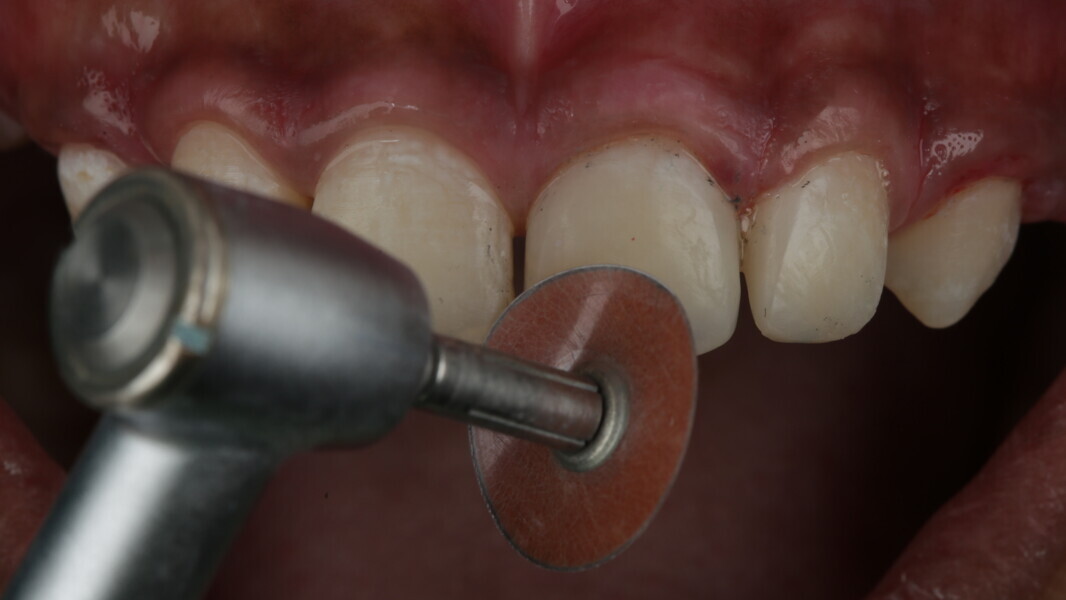 Fig 33: Sof-Lex finishing medium disc was used to reduce the surface roughness at a slow speed without irrigation.