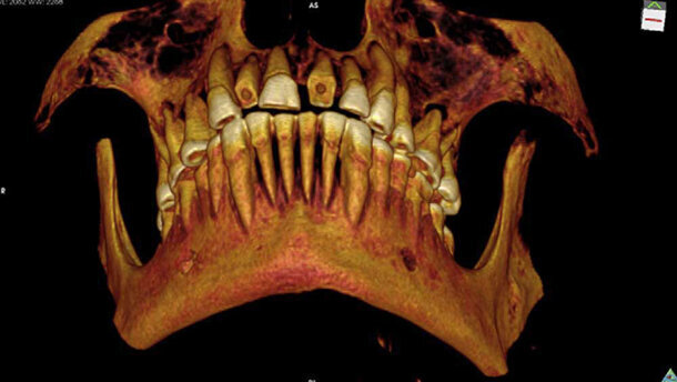 Mummie met gebit vol caviteiten ontdekt