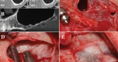 PRF brings new challenges to the dental office