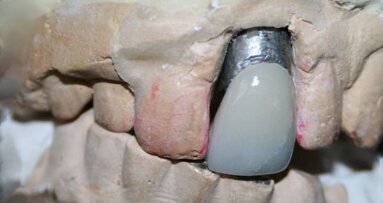 La dent d’Elvis exposée au Royaume-Uni, pour promouvoir la sensibilisation au cancer de la bouche