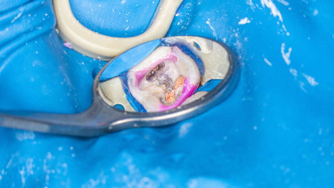 Fig. 37: Pulp chamber after obturation.