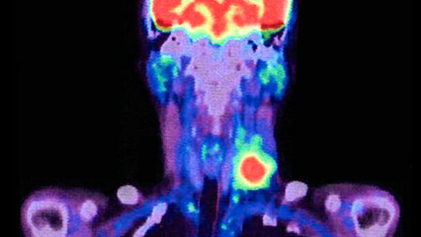 Tilmanocept: progresso significativo nella riduzione di complicanze chirurgiche nei tumori di testa e collo