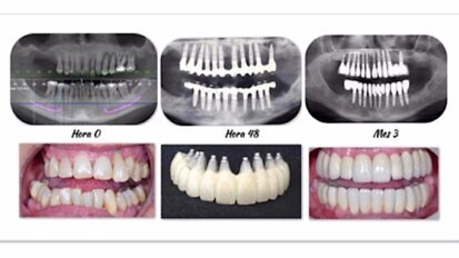 Los beneficios de la implantología biodinámica