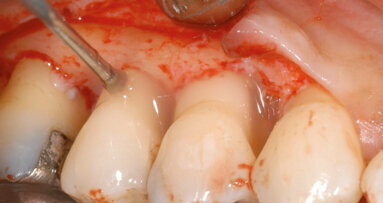 Ist gesteuerte Geweberegeneration ohne Inzision möglich?