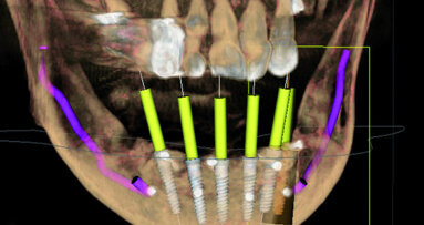 Advantages of 3-D planning for implants
