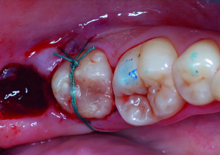 Fig. 17b: Clinical images: Tooth #48 positioned in the extraction site.