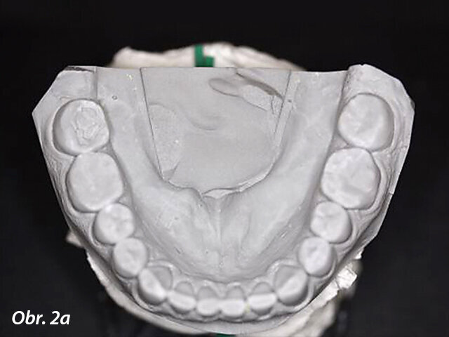 Obr. 2a, b: Sádrové modely dostupné z předešlé návštěvy