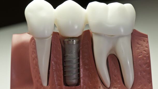 Gel stimuleert botgroei rond implantaat