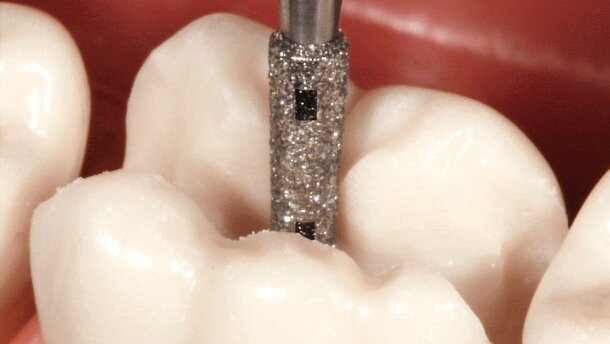 Online-Fortbildung: Keramisch präparieren heißt keramisch denken