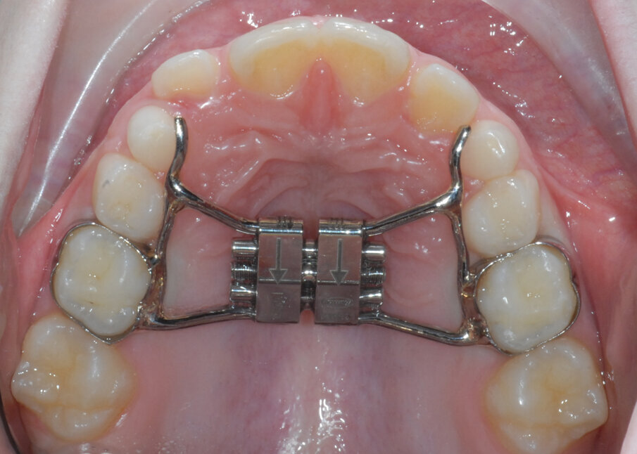 Fig. 5_Espansore rapido del palato ancorato su “E”.
