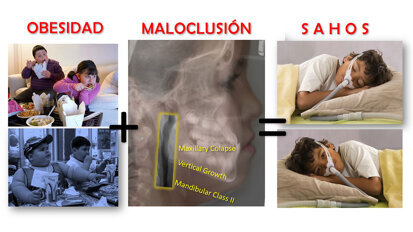 El papel del Ortodoncista en la Patología del Sueño (1) El papel del Ortodoncista en la Patología del Sueño (1)