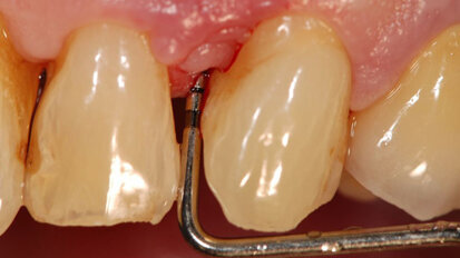 Rigenerazione parodontale  in zona estetica