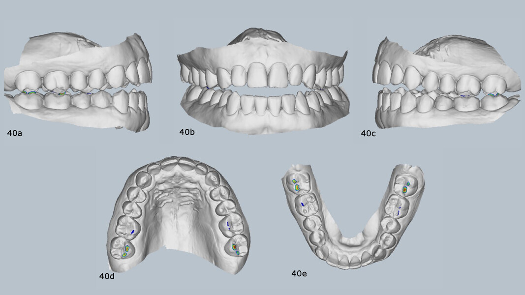 Figs. 40a–e: Pretreatment virtual articulator mounting with MODJAW demonstrating a discrepancy between maximum intercuspation and centric occlusion.