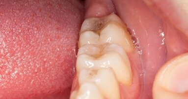 Диагностиката на слюнката може да промени денталната медицина