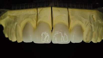 Disilicate de lithium – Une solution efficace pour les cas exigeants de la chirurgie esthétique