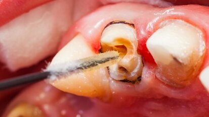 ובינר בנושא איטום תעלות שורש בתלת מימד