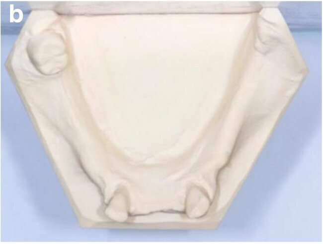 Fig. 3b: Frontal (a) and occlusal view (b) of the study models after extraction of teeth #41, 31 and 32.