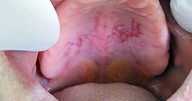 Protetická stomatitida: Ošetření diodovým laserem