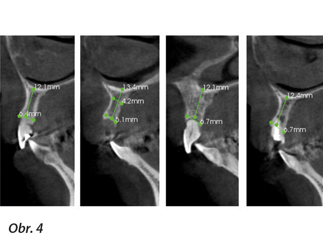 Obr. 4: Předoperační CT analýza
