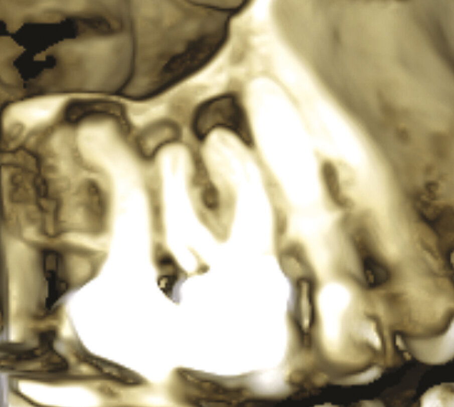 Figg. 1d, 1e - Un’altra lesione periapicale sta interessando il secondo molare.